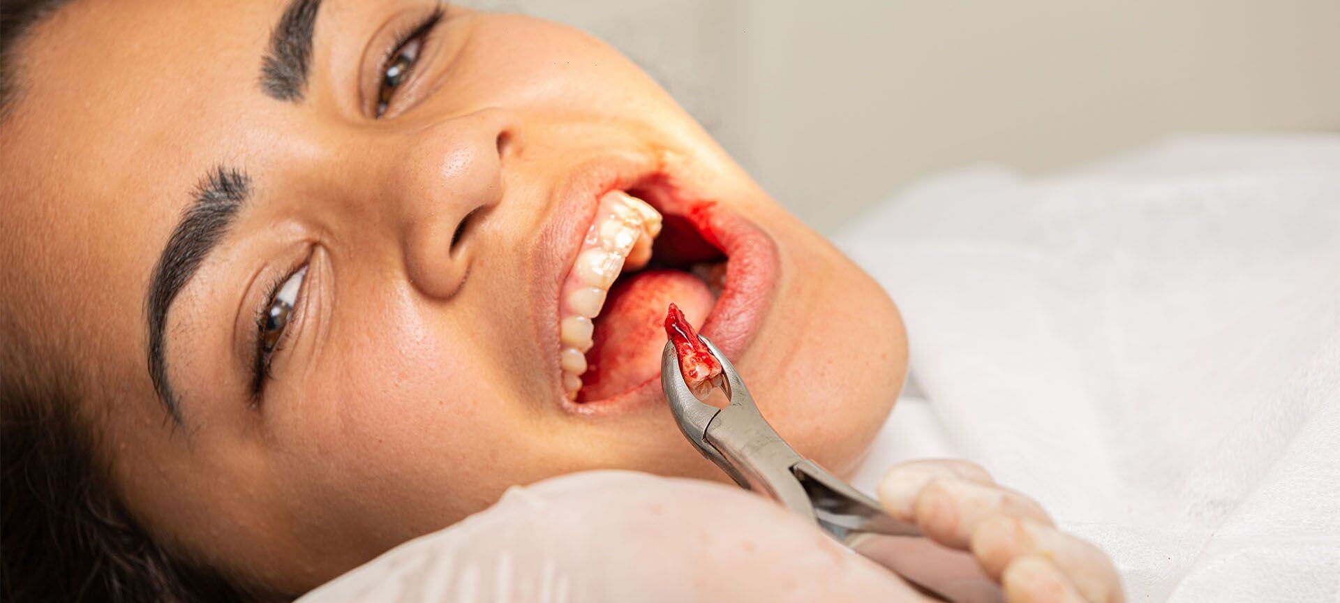 Wisdom Tooth Extraction Near Me