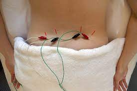 Electroacupuncture near me