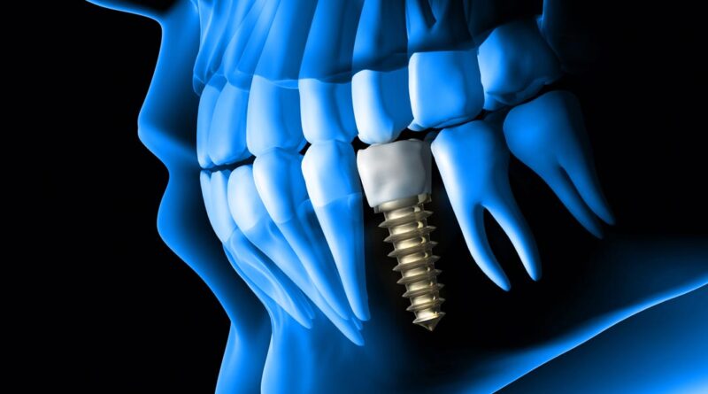 Dental Implants in Dubai