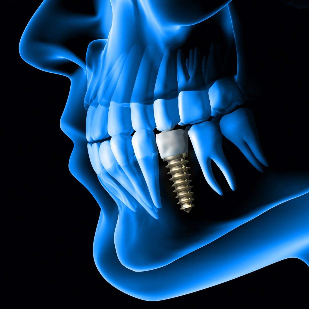 Dental Implant Specialists near me