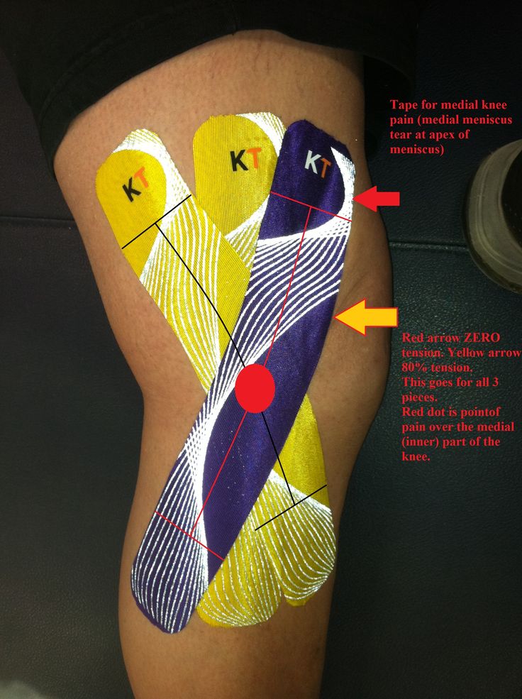 Meniscus knee pain location chart Mapping Pain to Find the Right