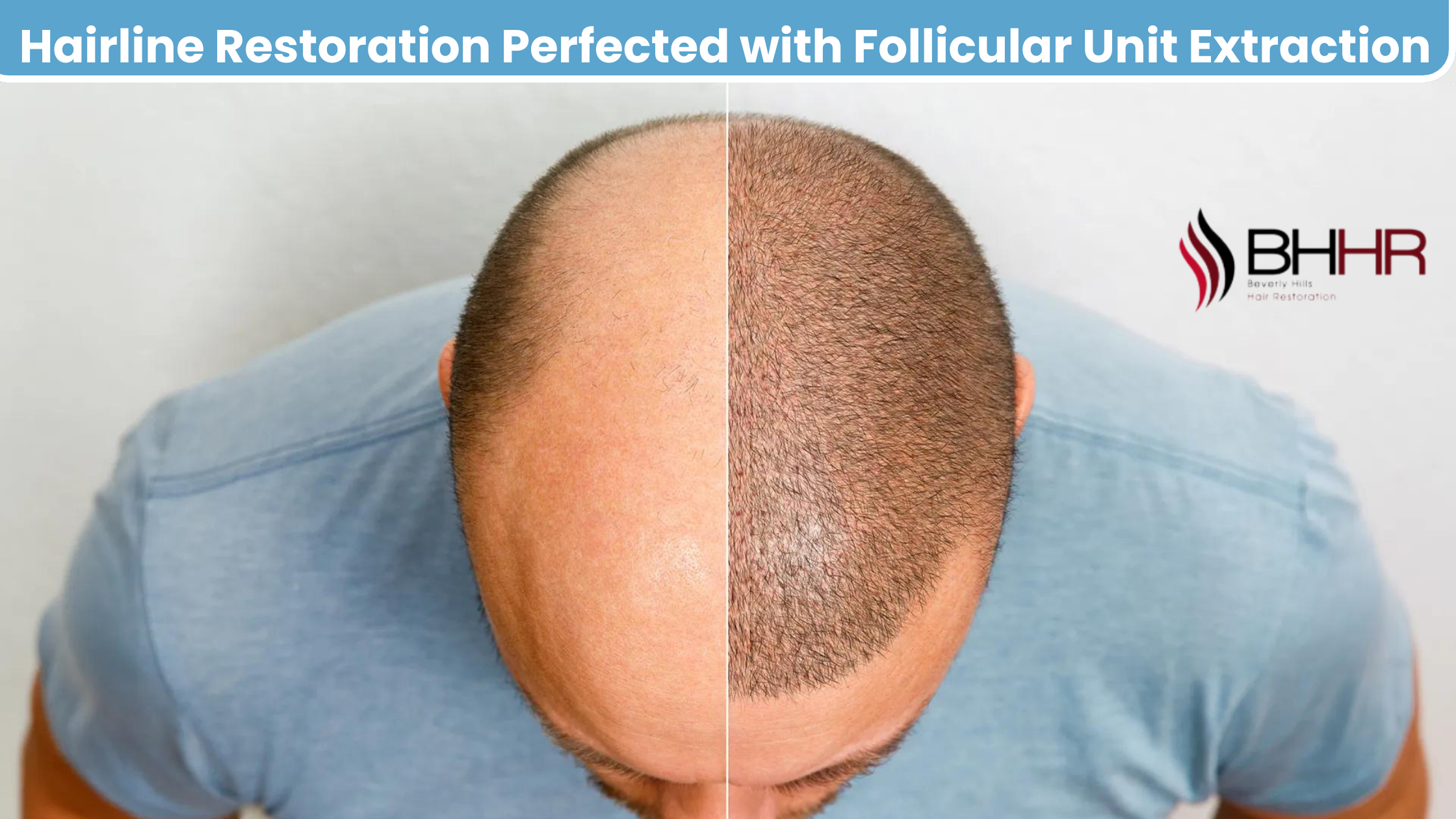 follicular unit extraction