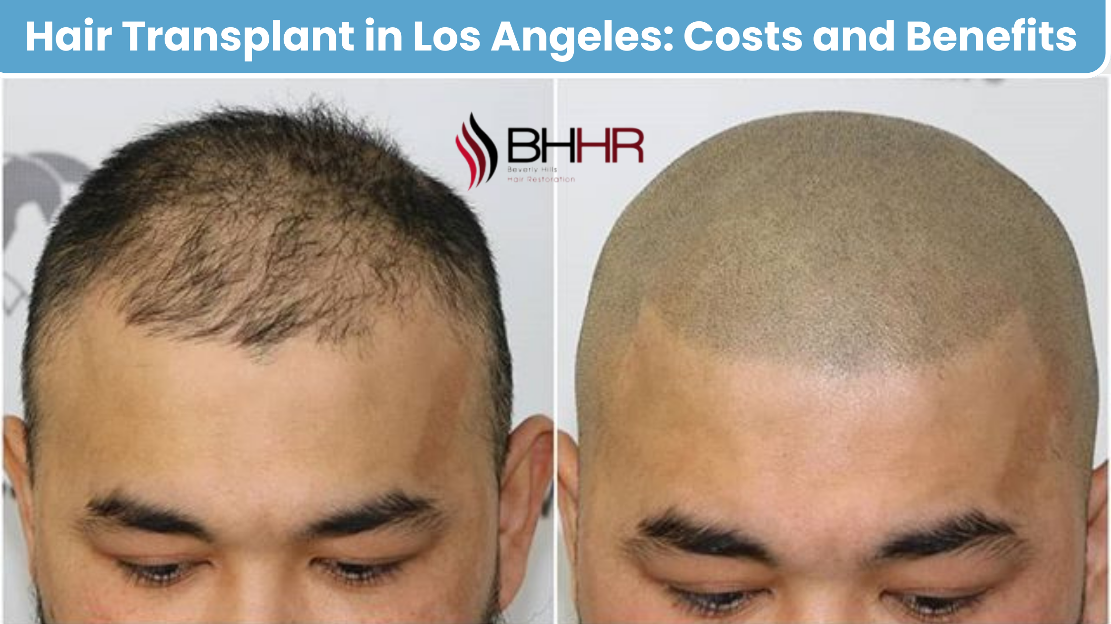 hair transplant cost los angeles